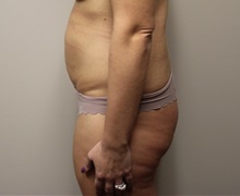 Tummy Tuck Before Photo by Kyle Shaddix, MD; Pensacola, FL - Case 38173