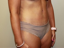 Tummy Tuck After Photo by Kyle Shaddix, MD; Pensacola, FL - Case 38173