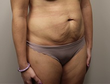 Tummy Tuck Before Photo by Kyle Shaddix, MD; Pensacola, FL - Case 38173