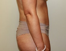 Tummy Tuck After Photo by Kyle Shaddix, MD; Pensacola, FL - Case 38173