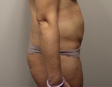 Tummy Tuck Before Photo by Kyle Shaddix, MD; Pensacola, FL - Case 38173