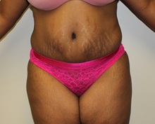 Tummy Tuck After Photo by Kyle Shaddix, MD; Pensacola, FL - Case 38176