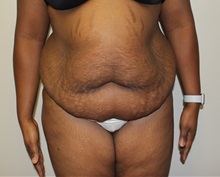 Tummy Tuck Before Photo by Kyle Shaddix, MD; Pensacola, FL - Case 38176