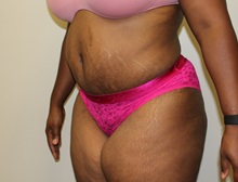 Tummy Tuck After Photo by Kyle Shaddix, MD; Pensacola, FL - Case 38176