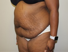 Tummy Tuck Before Photo by Kyle Shaddix, MD; Pensacola, FL - Case 38176