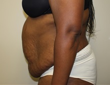 Tummy Tuck Before Photo by Kyle Shaddix, MD; Pensacola, FL - Case 38176
