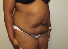 Tummy Tuck After Photo by Kyle Shaddix, MD; Pensacola, FL - Case 38176