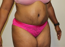 Tummy Tuck Before Photo by Kyle Shaddix, MD; Pensacola, FL - Case 38176