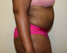 Tummy Tuck After Photo by Kyle Shaddix, MD; Pensacola, FL - Case 38176