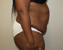 Tummy Tuck Before Photo by Kyle Shaddix, MD; Pensacola, FL - Case 38176