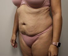 Tummy Tuck Before Photo by Kyle Shaddix, MD; Pensacola, FL - Case 38195