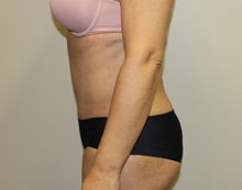 Tummy Tuck After Photo by Kyle Shaddix, MD; Pensacola, FL - Case 38195