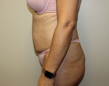 Tummy Tuck Before Photo by Kyle Shaddix, MD; Pensacola, FL - Case 38195
