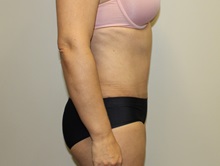 Tummy Tuck After Photo by Kyle Shaddix, MD; Pensacola, FL - Case 38195