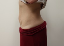Tummy Tuck Before Photo by Kyle Shaddix, MD; Pensacola, FL - Case 42882