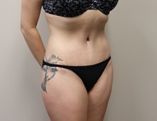 Tummy Tuck After Photo by Kyle Shaddix, MD; Pensacola, FL - Case 42882