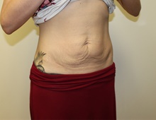Tummy Tuck Before Photo by Kyle Shaddix, MD; Pensacola, FL - Case 42882