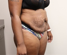 Tummy Tuck Before Photo by Kyle Shaddix, MD; Pensacola, FL - Case 42887