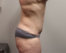 Tummy Tuck After Photo by Kyle Shaddix, MD; Pensacola, FL - Case 42893