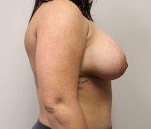 Breast Augmentation After Photo by Kyle Shaddix, MD; Pensacola, FL - Case 42932