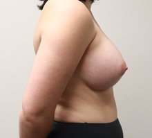 Breast Augmentation After Photo by Kyle Shaddix, MD; Pensacola, FL - Case 42937