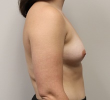 Breast Augmentation Before Photo by Kyle Shaddix, MD; Pensacola, FL - Case 42937