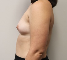 Breast Augmentation Before Photo by Kyle Shaddix, MD; Pensacola, FL - Case 42937