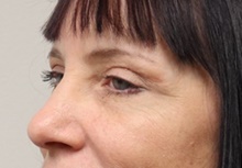 Eyelid Surgery After Photo by Kyle Shaddix, MD; Pensacola, FL - Case 42944