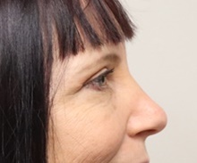 Eyelid Surgery After Photo by Kyle Shaddix, MD; Pensacola, FL - Case 42944