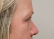 Eyelid Surgery After Photo by Kyle Shaddix, MD; Pensacola, FL - Case 42951