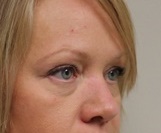 Eyelid Surgery Before Photo by Kyle Shaddix, MD; Pensacola, FL - Case 42951
