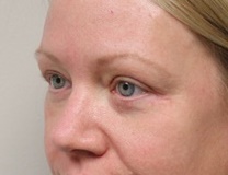 Eyelid Surgery Before Photo by Kyle Shaddix, MD; Pensacola, FL - Case 42951