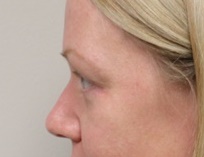 Eyelid Surgery After Photo by Kyle Shaddix, MD; Pensacola, FL - Case 42951
