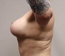Breast Lift After Photo by Kyle Shaddix, MD; Pensacola, FL - Case 42954