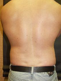 Liposuction After Photo by Richard Levin, MD; Towson, MD - Case 4278