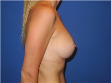 Breast Augmentation After Photo by Shahram Salemy, MD  FACS; Seattle, WA - Case 33118