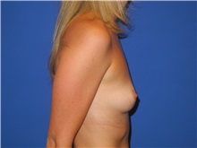 Breast Augmentation Before Photo by Shahram Salemy, MD  FACS; Seattle, WA - Case 33118
