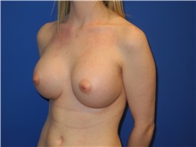 Breast Augmentation After Photo by Shahram Salemy, MD  FACS; Seattle, WA - Case 33120