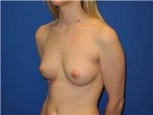 Breast Augmentation Before Photo by Shahram Salemy, MD  FACS; Seattle, WA - Case 33120