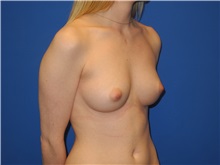 Breast Augmentation Before Photo by Shahram Salemy, MD  FACS; Seattle, WA - Case 33120