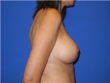 Breast Augmentation After Photo by Shahram Salemy, MD  FACS; Seattle, WA - Case 33349