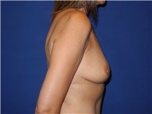 Breast Augmentation Before Photo by Shahram Salemy, MD  FACS; Seattle, WA - Case 33349