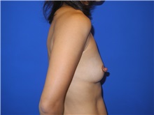 Breast Augmentation Before Photo by Shahram Salemy, MD  FACS; Seattle, WA - Case 33350