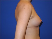 Breast Augmentation After Photo by Shahram Salemy, MD  FACS; Seattle, WA - Case 33351