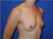 Breast Augmentation Before Photo by Shahram Salemy, MD  FACS; Seattle, WA - Case 33351