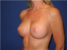Breast Augmentation After Photo by Shahram Salemy, MD  FACS; Seattle, WA - Case 33526