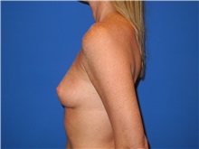 Breast Augmentation Before Photo by Shahram Salemy, MD  FACS; Seattle, WA - Case 33526