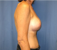 Breast Lift After Photo by Samuel Lien, MD; Everett, WA - Case 39072