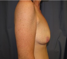Breast Lift Before Photo by Samuel Lien, MD; Everett, WA - Case 39072