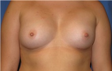 Breast Augmentation After Photo by Samuel Lien, MD; Everett, WA - Case 39073